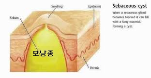 모낭종.jpg