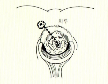 크기변환_치루테두리 없슴.jpg